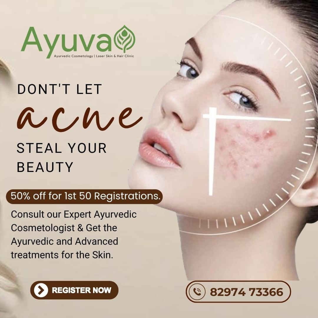 Don’t Let Acne Steal Your Beauty!