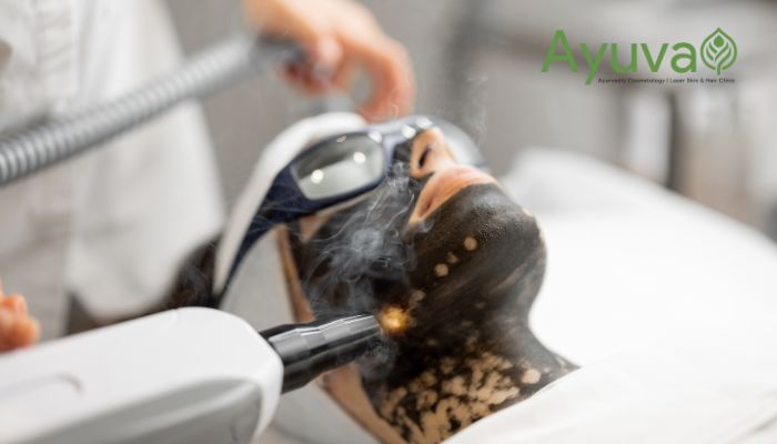 carbon peel Treatment