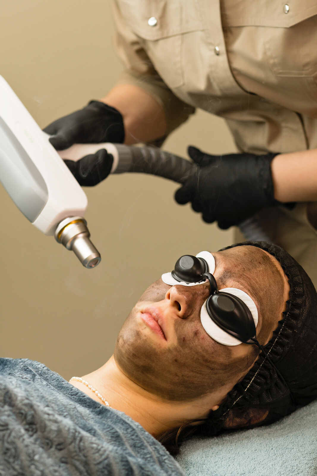 Carbon Facial Treatment in Hyderabad