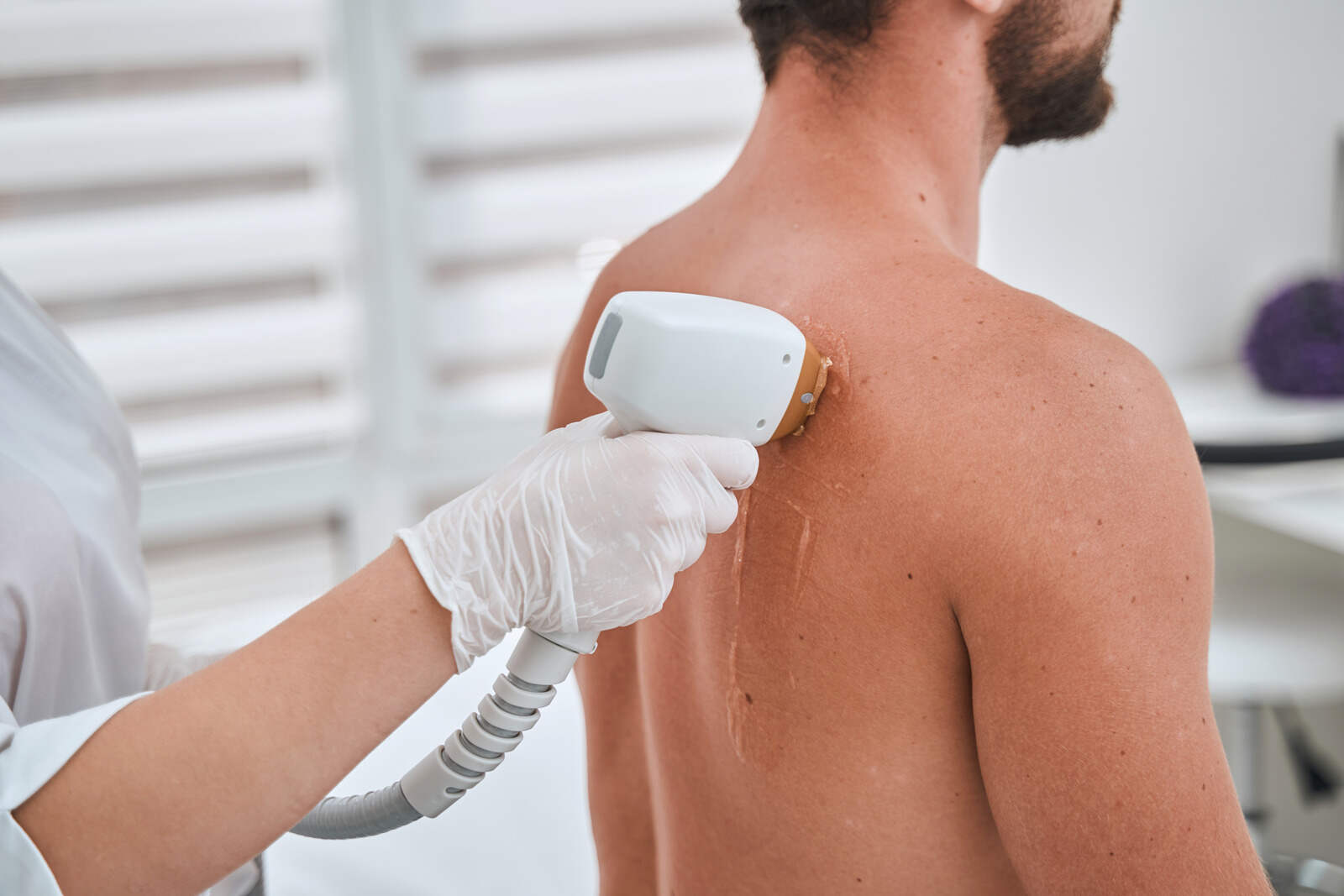 Laser Hair Removal for Back