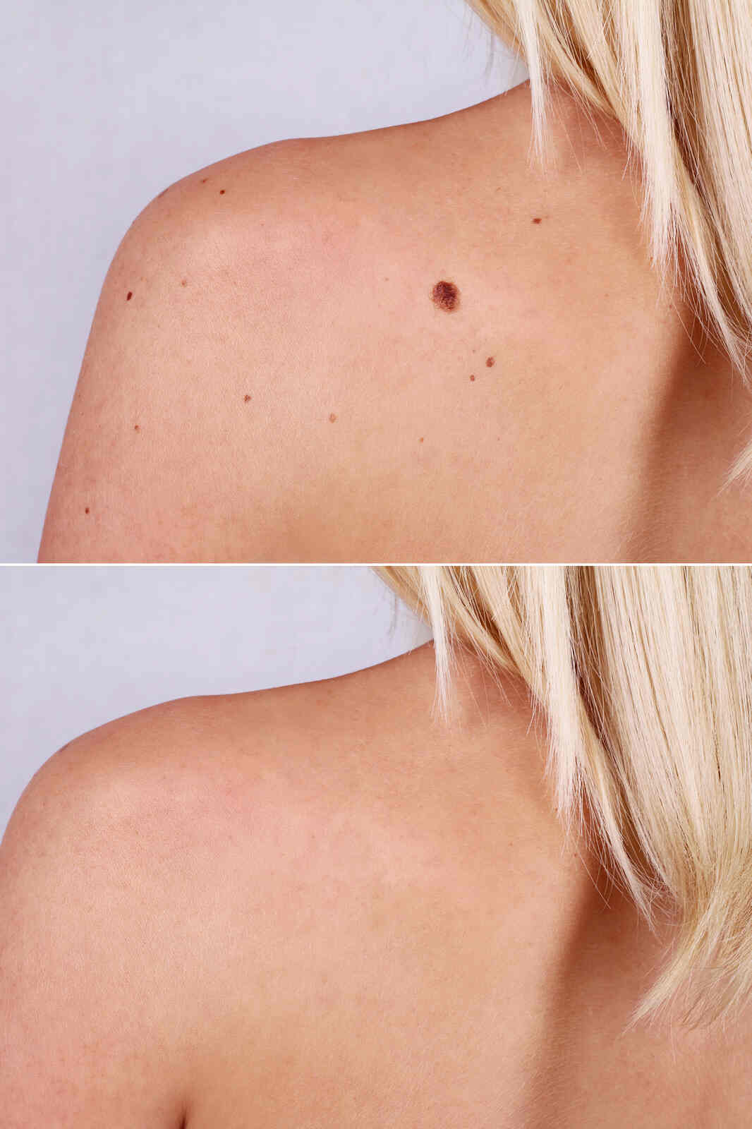 Skin Tag Removal in Ayuva Hyderabad