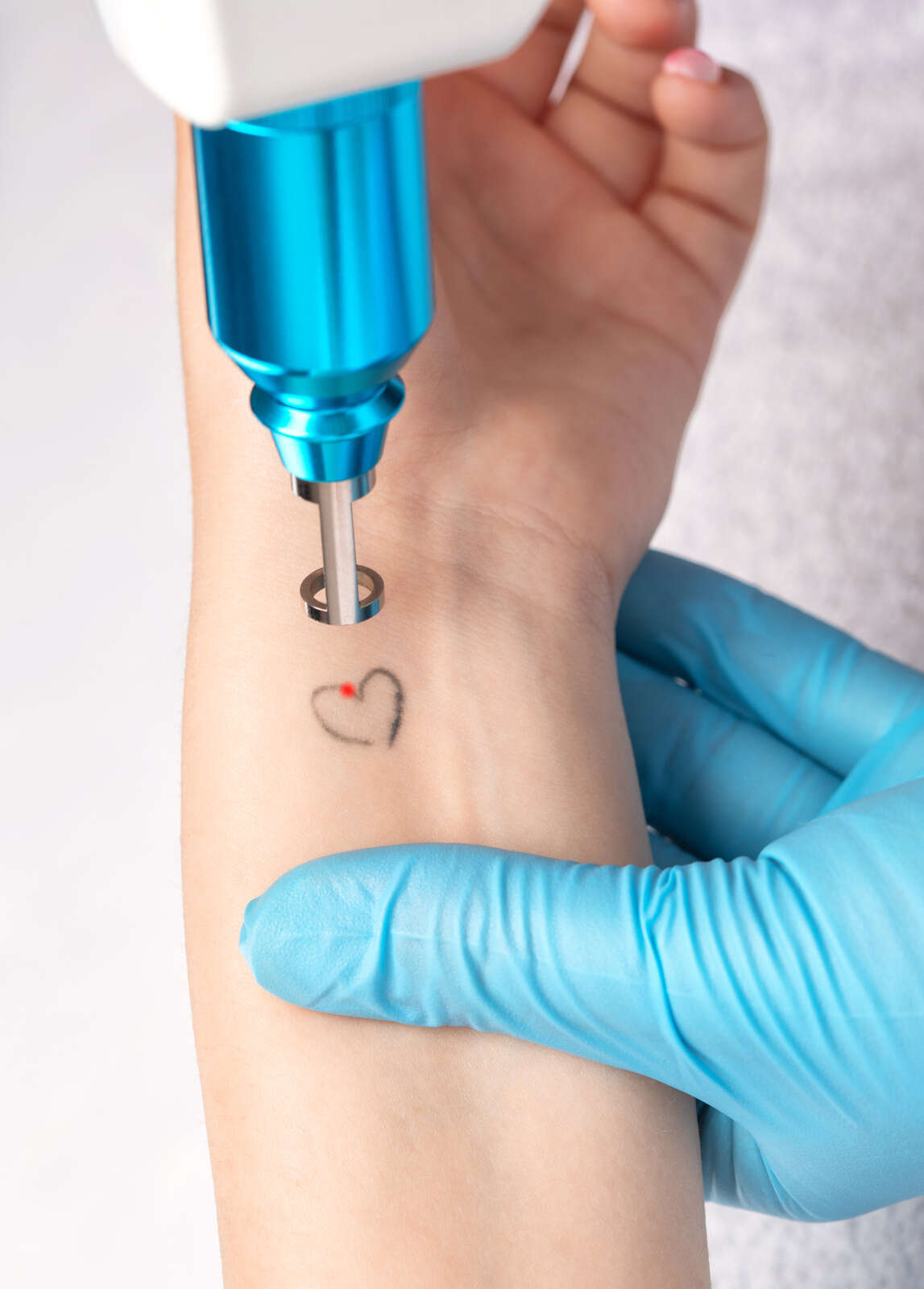 Tattoo Removal Treatments At Ayuva Hyderabad