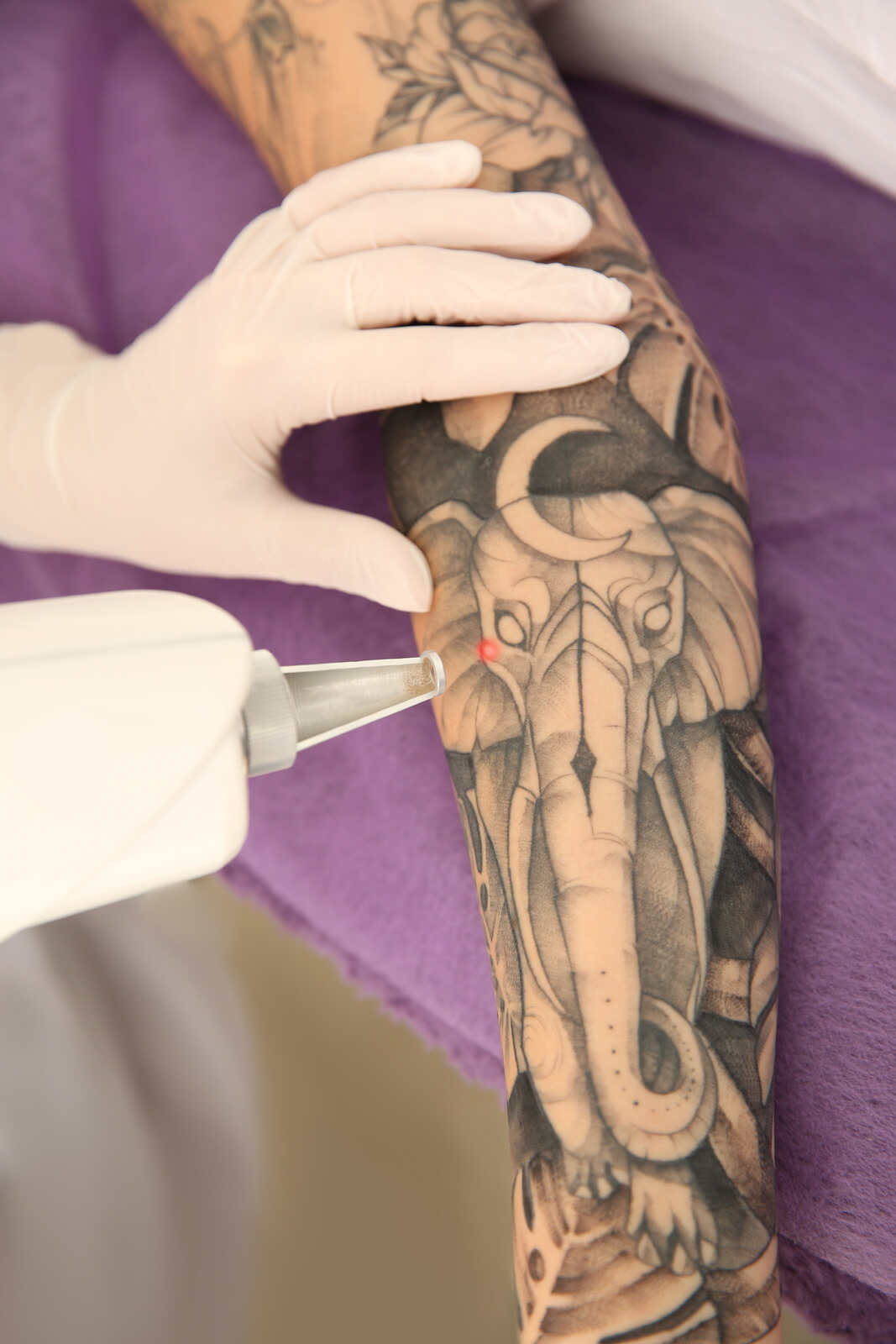 Tattoo Removal Treatments At Ayuva Hyderabad