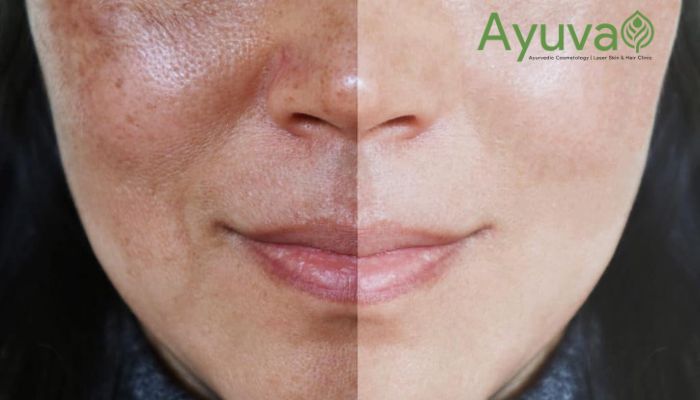 best treatment for melasma on face